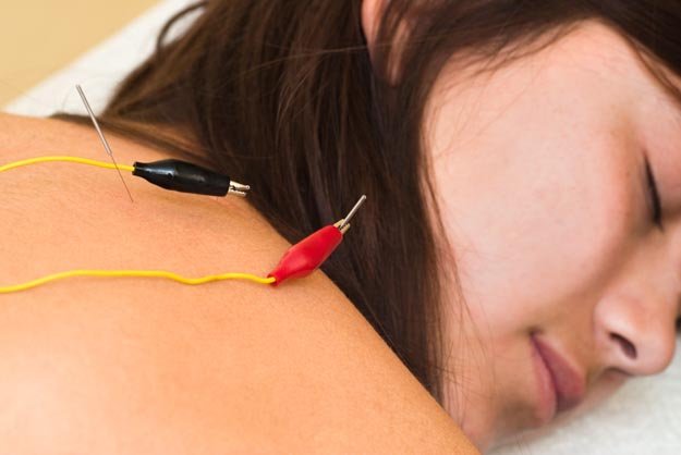 La acupuntura alivia el dolor de cuello, aumenta Movimiento