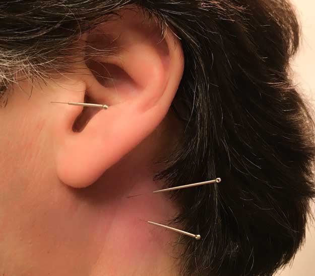 La acupuntura alivia el tinnitus
