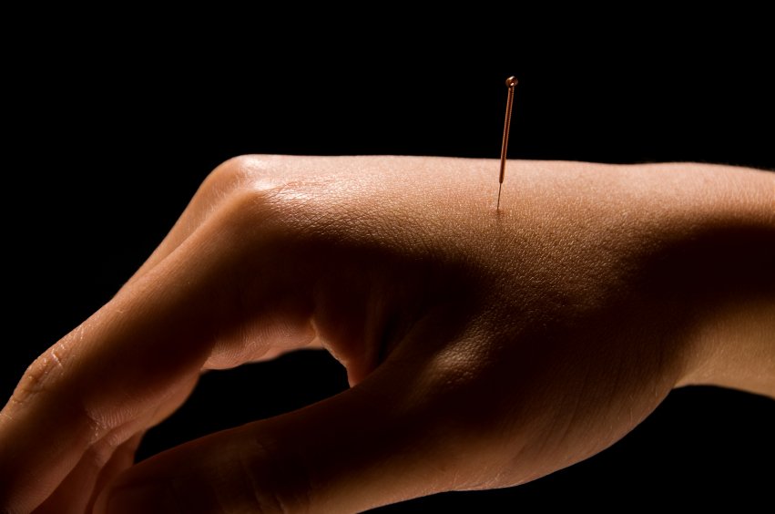 Por que la acupuntura es el mejor Medicamento Para El dolor?.