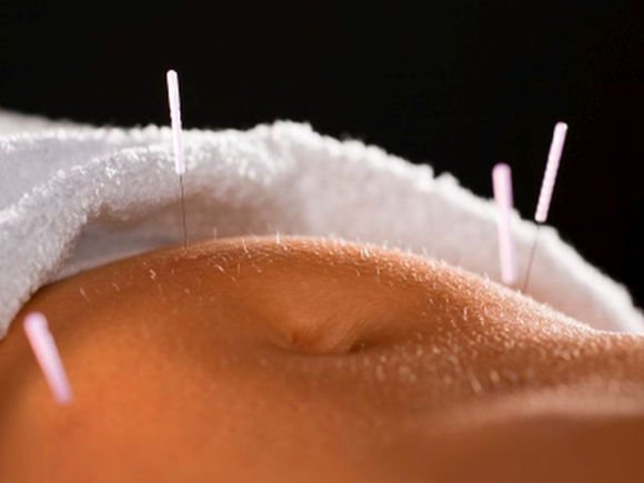 La acupuntura trata eficazmente el estreimiento